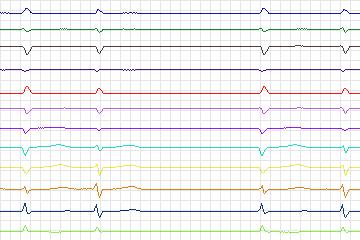 s0024bre-patient164 thumbnail