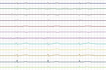s0074lre-patient022 thumbnail