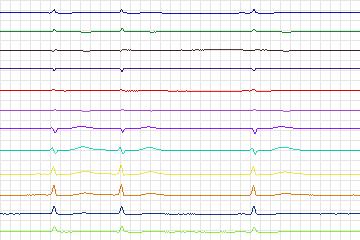 s0081lre-patient023 thumbnail