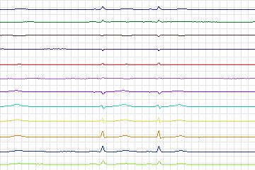 s0085lre-patient023 thumbnail