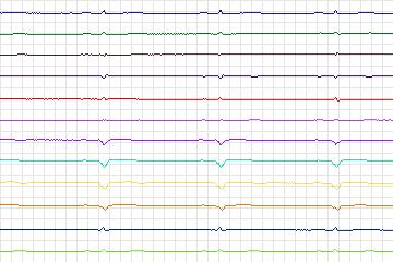 s0086lre-patient024 thumbnail
