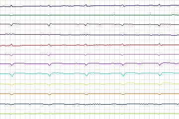 s0092lre-patient029 thumbnail