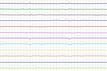 s0093lre-patient028 thumbnail
