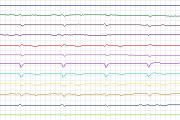 s0099lre-patient030 thumbnail