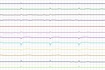 s0111lre-patient036 thumbnail