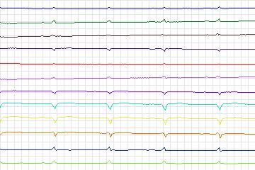 s0118lre-patient034 thumbnail
