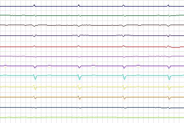 s0119lre-patient035 thumbnail