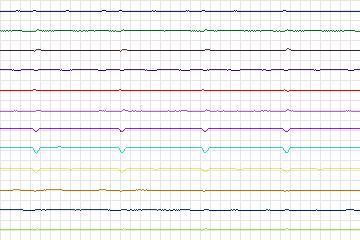 s0122lre-patient029 thumbnail