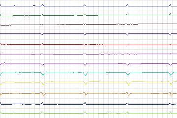 s0123lre-patient034 thumbnail