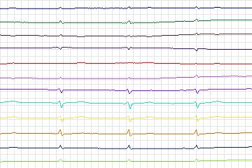 s0131lre-patient040 thumbnail
