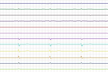s0133lre-patient040 thumbnail