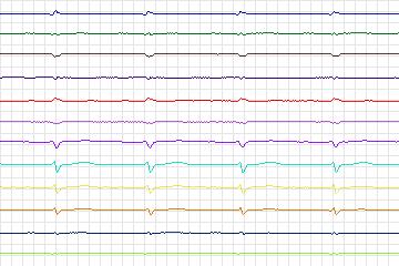 s0136lre-patient041 thumbnail