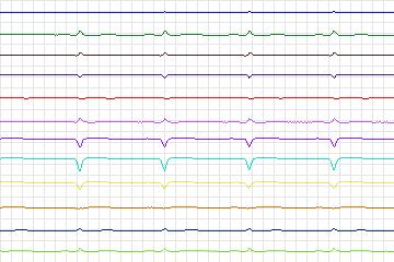 s0137lre-patient042 thumbnail