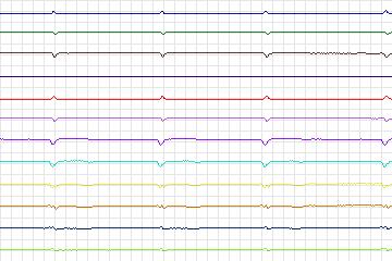 s0153lre-patient030 thumbnail