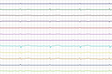 s0158lre-patient034 thumbnail