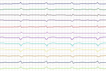 s0160lre-patient047 thumbnail