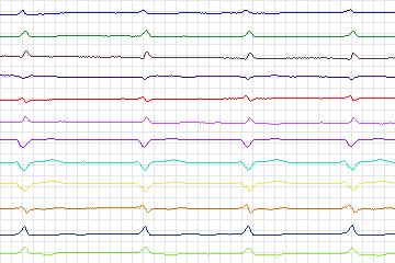 s0163lre-patient047 thumbnail