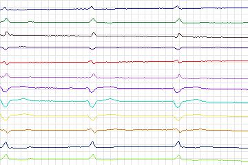 s0167lre-patient047 thumbnail