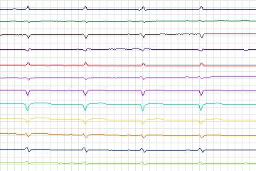 s0168lre-patient046 thumbnail