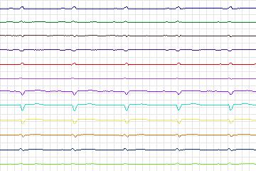 s0171lre-patient048 thumbnail