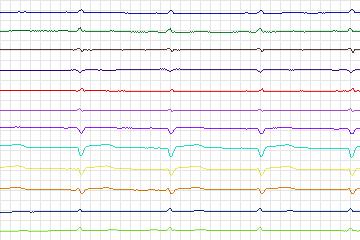 s0172lre-patient048 thumbnail