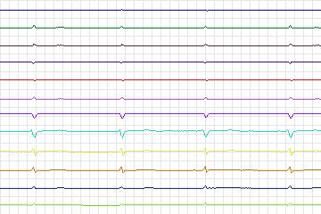 s0173lre-patient049 thumbnail