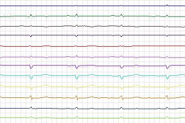 s0174lre-patient050 thumbnail