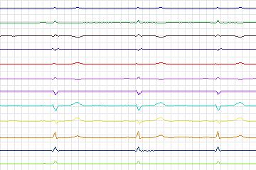 s0177lre-patient050 thumbnail