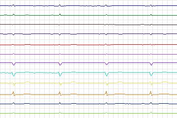 s0178lre-patient049 thumbnail