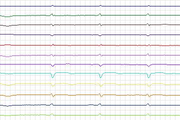 s0180lre-patient048 thumbnail