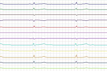 s0181lre-patient051 thumbnail