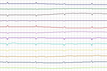 s0184lre-patient046 thumbnail
