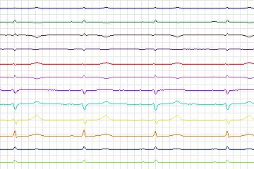 s0185lre-patient050 thumbnail