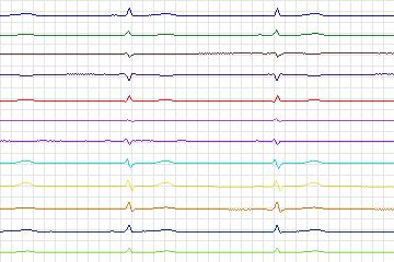 s0187lre-patient051 thumbnail