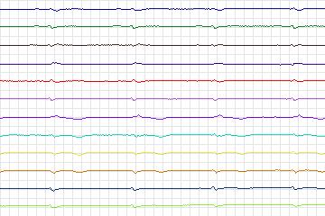 s0191lre-patient053 thumbnail