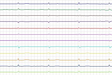 s0198lre-patient057 thumbnail