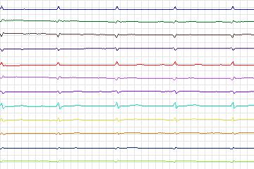 s0208lre-patient059 thumbnail