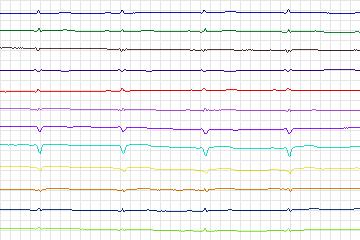 s0209lre-patient060 thumbnail