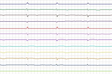 s0212lre-patient062 thumbnail