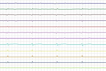 s0217lre-patient045 thumbnail