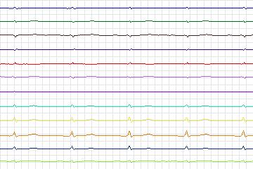s0220lre-patient064 thumbnail