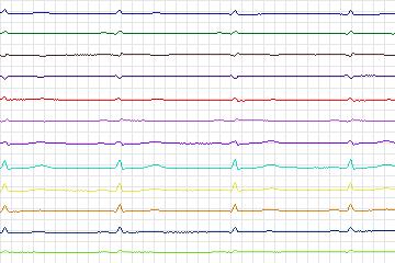 s0221lre-patient065 thumbnail