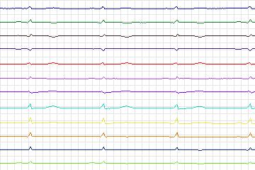 s0229lre-patient065 thumbnail