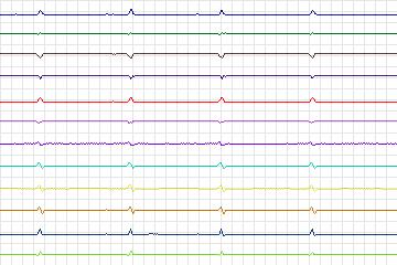 s0241lre-patient074 thumbnail