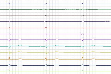 s0244lre-patient072 thumbnail