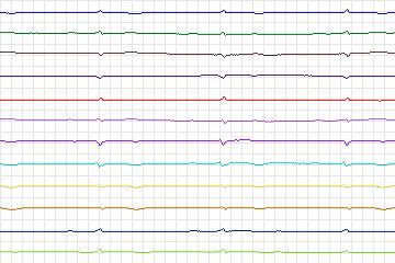 s0252lre-patient073 thumbnail