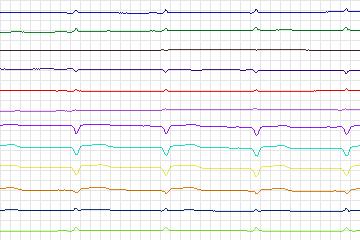 s0271lre-patient082 thumbnail
