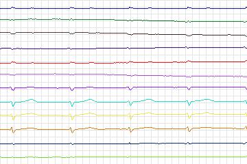 s0276lre-patient041 thumbnail