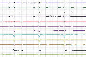 s0277lre-patient048 thumbnail