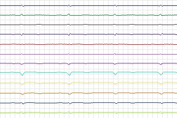 s0281lre-patient084 thumbnail